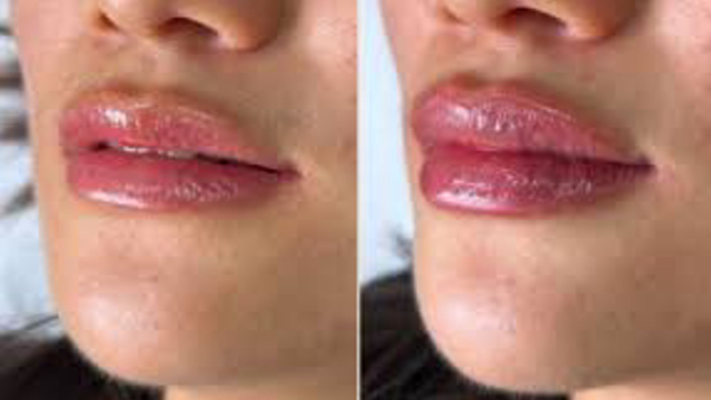 Lip Filler 0.5ml